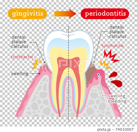 歯槽膿漏の説明 イラスト 英語のイラスト素材
