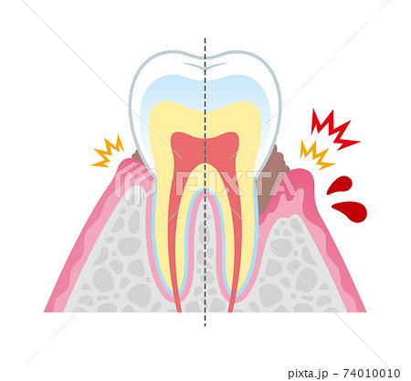 歯槽膿漏　イラスト 74010010