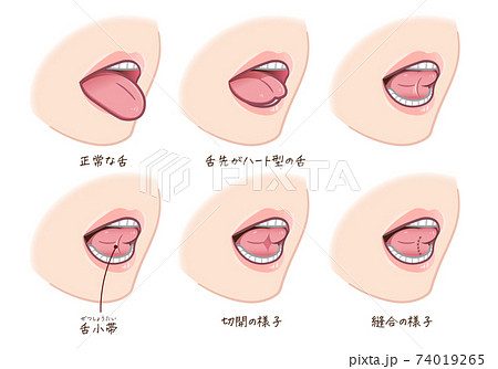 舌小帯短縮症のイラストのイラスト素材