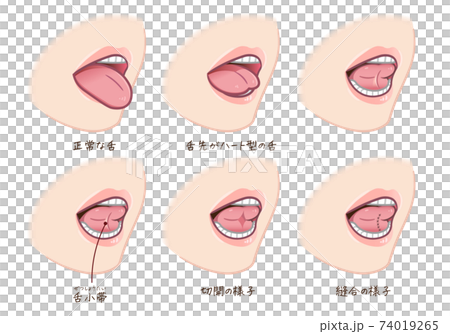 舌小帯短縮症のイラストのイラスト素材