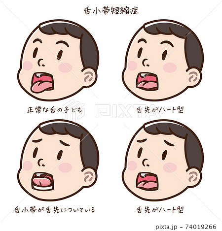 舌小帯短縮症の子どものイラストのイラスト素材