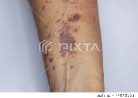 The physical appearance of the arm with the wound is caused by Haemophilia, (Haemophiliais a mostly inherited genetic disorder) The physical appearance of the arm with the wound is caused by Haemophilia, (Haemophiliais a mostly inherited genetic disorder) 74040553