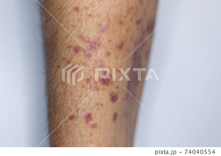 The physical appearance of the arm with the wound is caused by Haemophilia, (Haemophiliais a mostly inherited genetic disorder) The physical appearance of the arm with the wound is caused by Haemophilia, (Haemophiliais a mostly inherited genetic disorder) 74040554