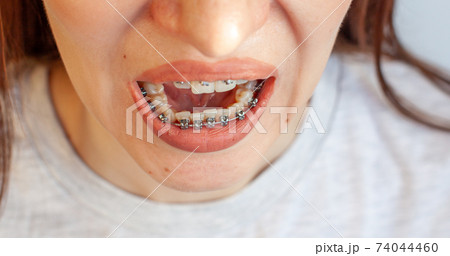 Braces in the smiling mouth of a girl. Smooth teeth from braces. 74044460