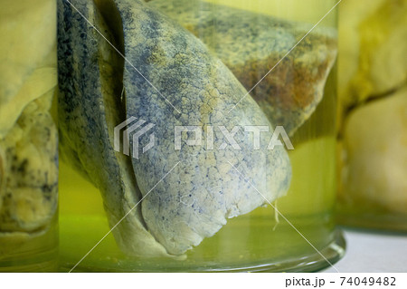 Lungs with cancerous changes floating inside jar with formaldehyde in morgue 74049482