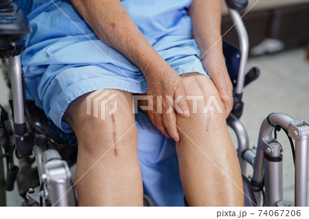Asian senior or elderly old lady woman patient show her scars surgical total knee joint replacement Suture wound surgery arthroplasty on bed in nursing hospital ward Asian senior or elderly old lady woman patient show her scars surgical total knee joint replacement Suture wound surgery arthroplasty on bed in nursing hospital ward 74067206