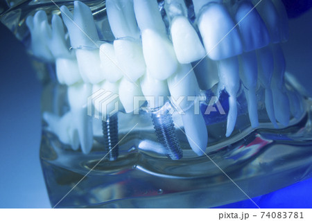 Dental tooth implant 74083781