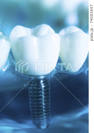 Dental tooth implant Dental tooth implant 74083847