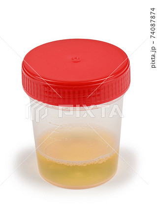 Urine sample in container. Urine sample in container. 74087874