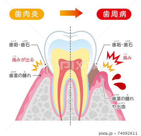 歯槽膿漏の説明 イラストのイラスト素材
