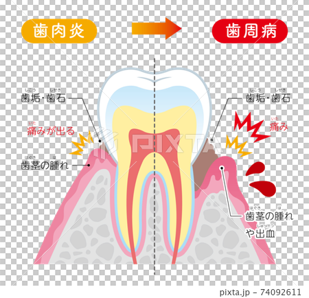肺泡膿性插圖的解釋 74092611