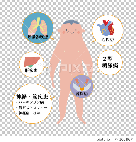 シニア男性をモデルにした基礎疾患の説明図 イラスト シニア男性をモデルにした基礎疾患の説明図 イラスト 74103967