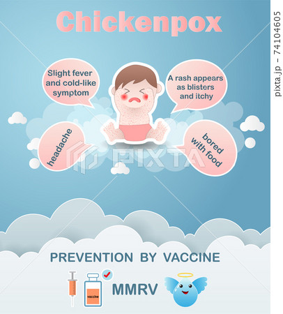 Infographics varicella virus.The kid boy sick chickenpox.Prevention and symptom of disease by vaccine MMRV.Cartoons of varicella virus, diagnostics. Vector illustration Infographics varicella virus.The kid boy sick chickenpox.Prevention and symptom of disease by vaccine MMRV.Cartoons of varicella virus, diagnostics. Vector illustration 74104605