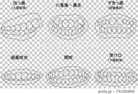歯列矯正治療の対象になる代表的な症例線画セット 歯列矯正治療の対象になる代表的な症例線画セット 74190960