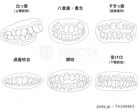 歯列矯正治療の対象になる代表的な症例線画セット デッサン調のイラスト素材