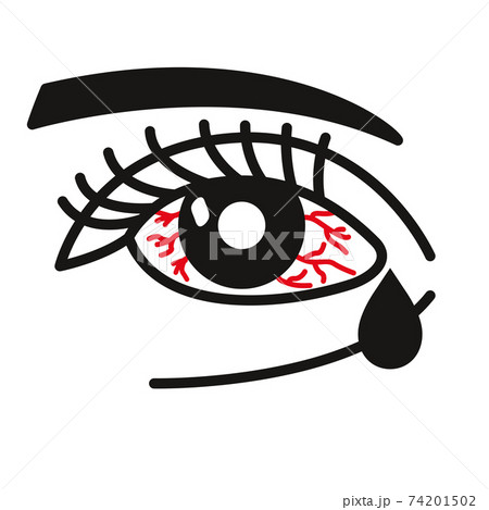 Inflammated eye Conjunctivitis or pink eye 74201502