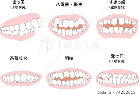 歯列矯正治療の対象になる代表的な症例セット ベタ塗り線ありのイラスト素材