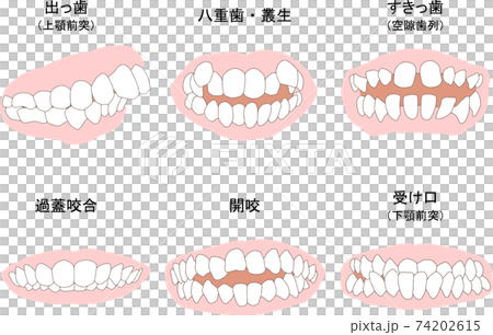 歯列矯正治療の対象になる代表的な症例セット　ベタ塗り線あり 74202615