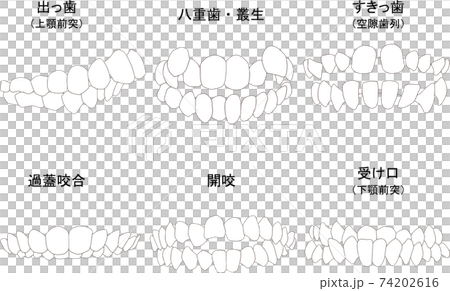 歯列矯正治療の対象になる代表的な症例セット（歯のみ）　ベタ塗り線あり 74202616