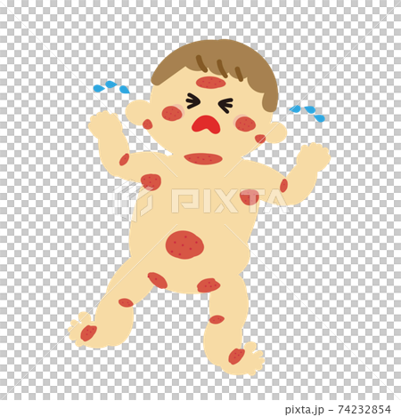 Baby rough skin itchy 74232854