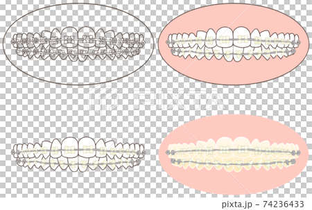 陶瓷支架安裝套件，用於正確的牙齒和正畸治療 74236433
