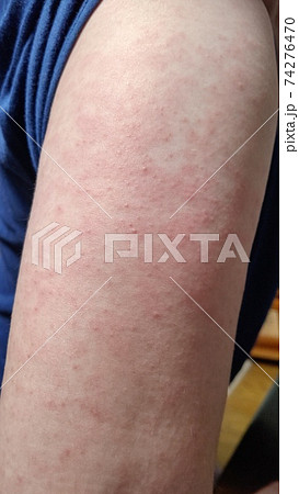 薬疹 腕 薬疹 腕 74276470
