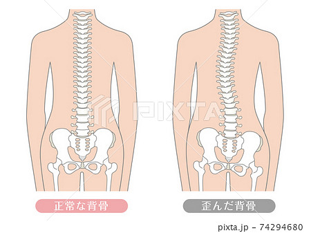 人間の体 正常な背骨と歪んだ背骨のイラスト素材