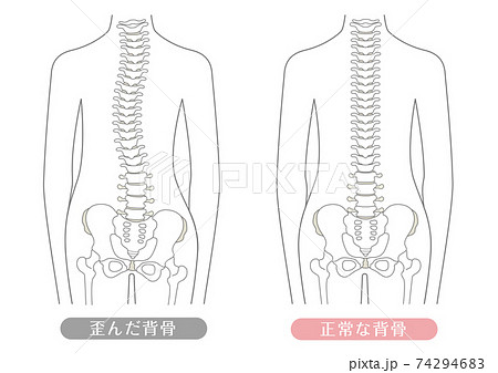 人間の体 正常な背骨と歪んだ背骨のイラスト素材