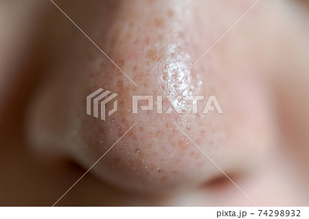 いちご鼻 74298932