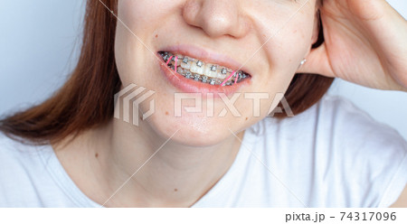 Braces in the smiling mouth of a girl. Smooth teeth from braces. Braces in the smiling mouth of a girl. Smooth teeth from braces. 74317096
