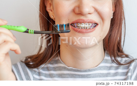 Braces in the smiling mouth of a girl. Smooth teeth from braces. 74317198