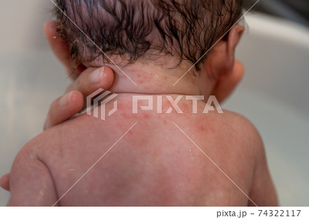 乳児湿疹がでている新生児の背中 乳児湿疹がでている新生児の背中 74322117