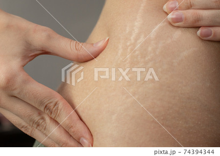 Young woman showing stretch marks on her body. 74394344
