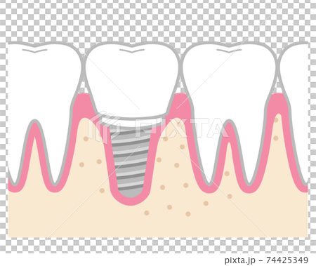 Tooth implant 74425349