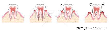 歯　歯周病 74426263
