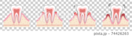 歯　歯周病 74426263