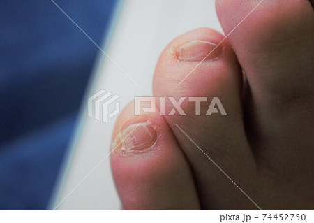左足の小指 左足の小指 74452750