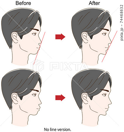 歯列矯正をした成人男性の横顔ビフォーアフターイメージのイラスト素材