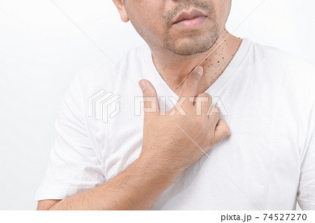 Man point to Skin Tags or Acrochordon on neck man on white background. Man point to Skin Tags or Acrochordon on neck man on white background. 74527270