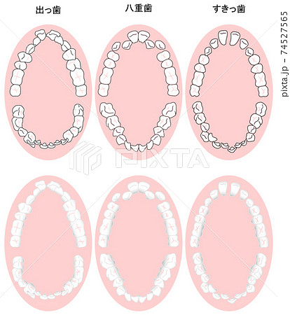歯列矯正治療の対象になる代表的な症例を上から見た図セット　カラー 74527565
