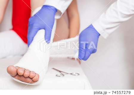 Leg bandaged in a tight dressing, plaster cast for fracture of the