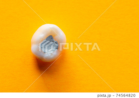 Tooth with a filling close-up on a yellow background Tooth with a filling close-up on a yellow background 74564820
