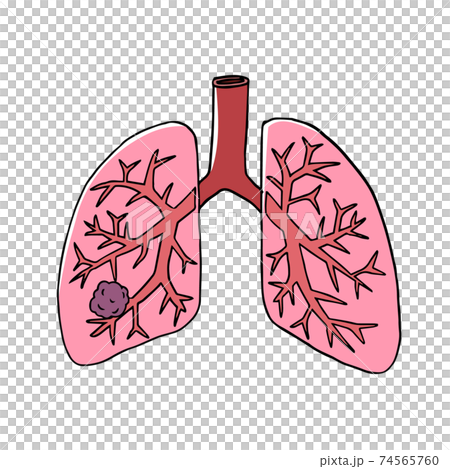 Image of lung cancer 74565760