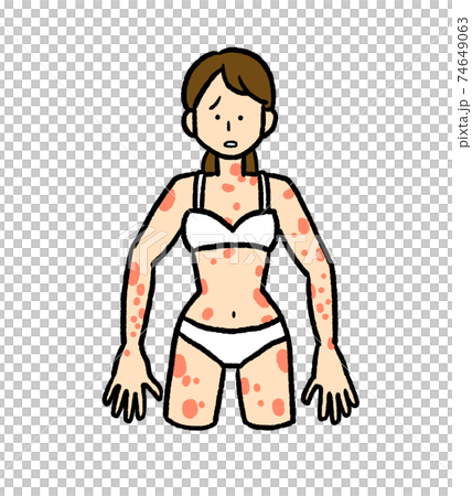 蕁麻疹症狀的女人的插圖 蕁麻疹症狀的女人的插圖 74649063