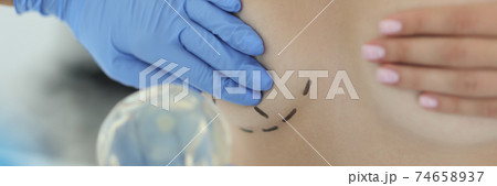 Hand in rubber medical glove holds woman's mammary gland with drawn line around closeup 74658937