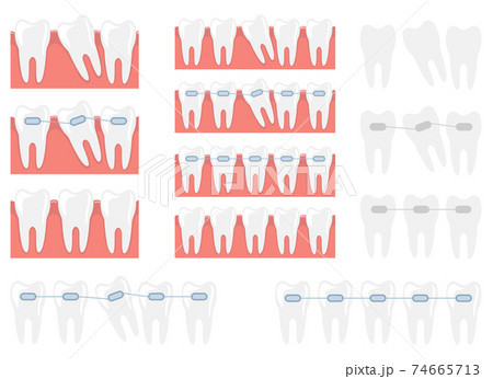 Braces vector design illustration isolated on white background Braces vector design illustration isolated on white background 74665713
