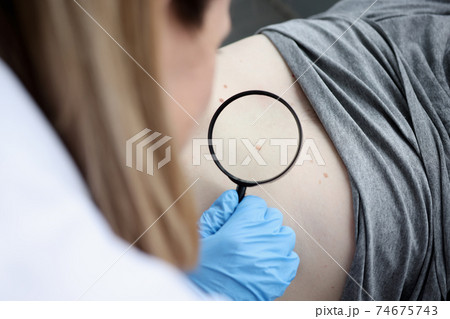 Doctor oncologist examining pigmented nevus using magnifying glass closeup Doctor oncologist examining pigmented nevus using magnifying glass closeup 74675743