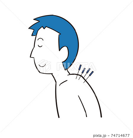 肩を鍼治療する男性 74714677