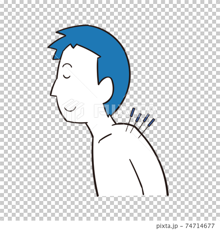 肩を鍼治療する男性 74714677