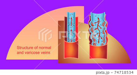 Varicose veins on a female senior legs. The structure of normal and varicose veins. Varicose veins on a female senior legs. The structure of normal and varicose veins. 74718534